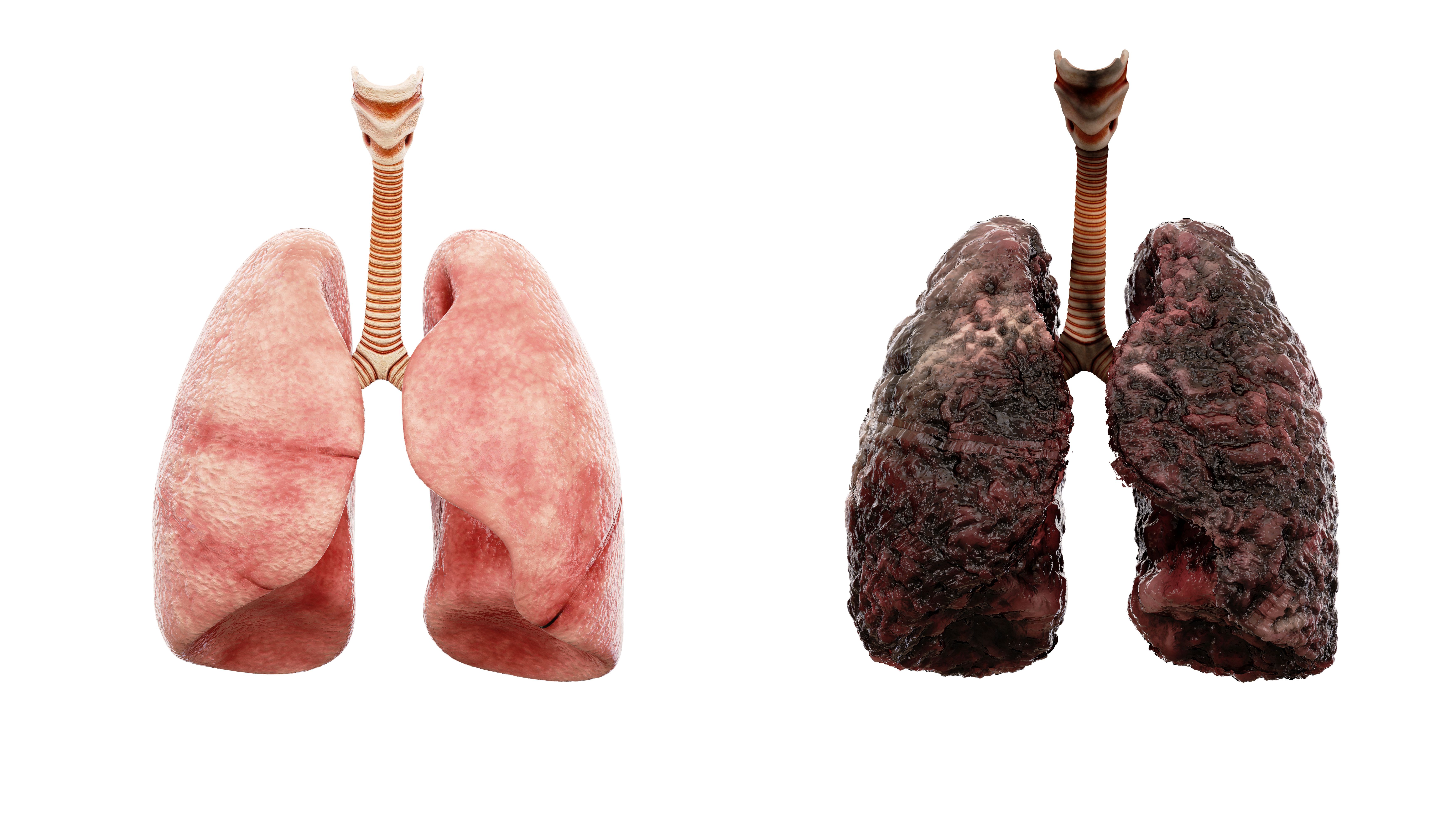 Nine Silent Signs Of Lung Cancer Revealed